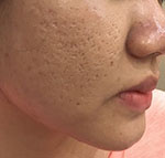 Vết thâm, sẹo lồi